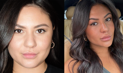 Lip Filler Before After Volume Enhancement Mississauga Lip Doctor